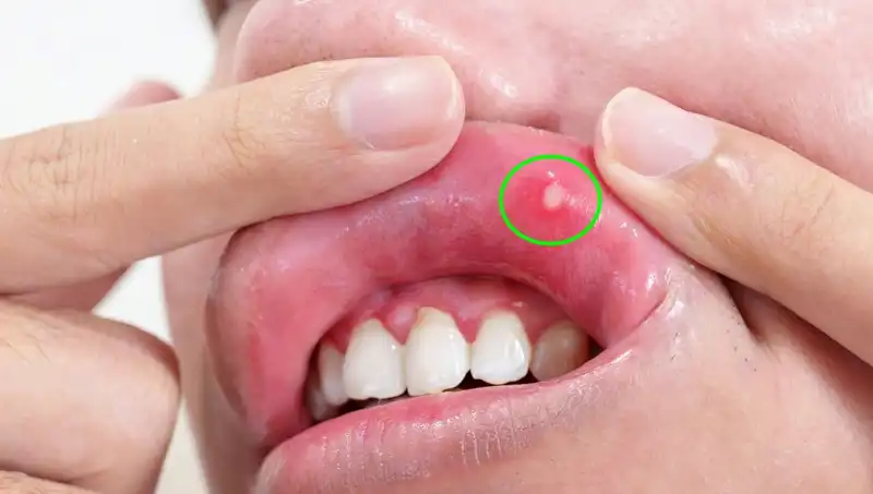 B Vitamini Eksikliği: Sağlığınıza Zarar Verebilecek 5 Belirgin Belirtisi